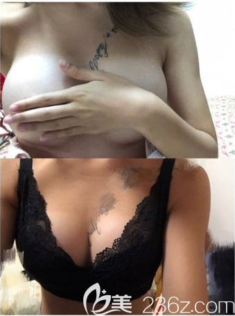 韩国PJS朴真奭隆胸真人案例 韩国PJS朴真奭隆胸真人案例