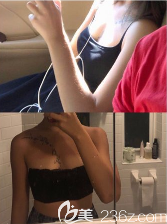 韩国PJS朴真奭做胸怎么样 韩国PJS朴真奭做胸怎么样