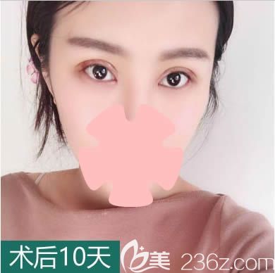 在长春中妍整形做双眼皮10天后照 在长春中妍整形做双眼皮10天后照