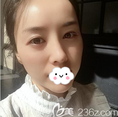 石晓军玻尿酸填充全脸第5天恢复照片