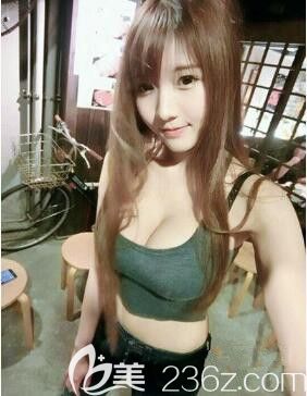 鲁天宇自体脂肪丰胸术后19天 鲁天宇自体脂肪丰胸术后19天