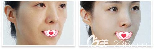 秦皇岛念奴娇注射玻尿酸填充面部案例