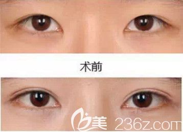念奴娇整形做双眼皮手术案例