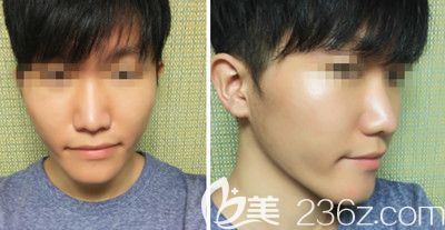 在韩国本爱做鼻综合手术前 在韩国本爱做鼻综合手术前