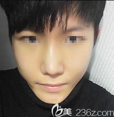 在韩国本爱做鼻综合手术后1个月 在韩国本爱做鼻综合手术后1个月