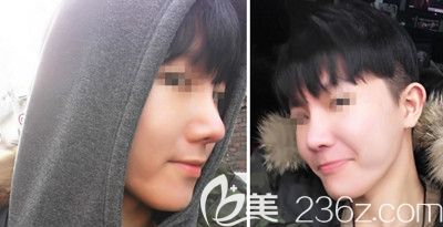 在韩国本爱医院做了鼻综合手术后3个月就告别了我的大鼻头