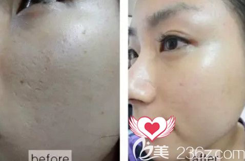 秦皇岛念奴娇注射案例