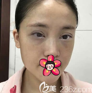 杭州薇琳医美刚做完双眼皮照片