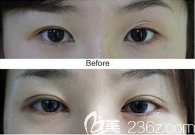 成镇魔双眼皮修复案例效果对比图