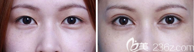 惠州伊丽莎白金鸿医生双眼皮手术案例 惠州伊丽莎白金鸿医生双眼皮手术案例