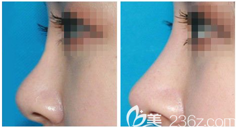 惠州伊丽莎白金鸿院长隆鼻案例对比图 惠州伊丽莎白金鸿院长隆鼻案例对比图