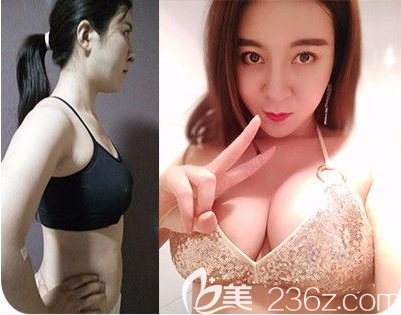 惠州伊丽莎白金鸿院长做的隆胸案例 惠州伊丽莎白金鸿院长做的隆胸案例