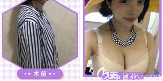 遵义利美康假体丰胸案例 遵义利美康假体丰胸案例