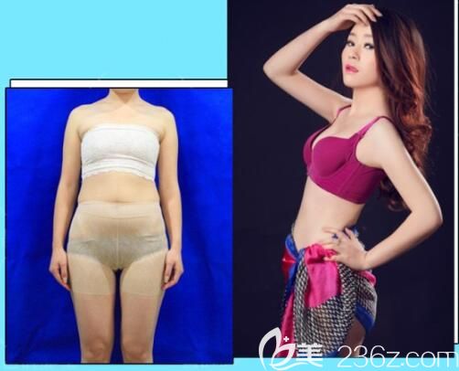 遵义利美康吸脂怎么样 遵义利美康吸脂怎么样