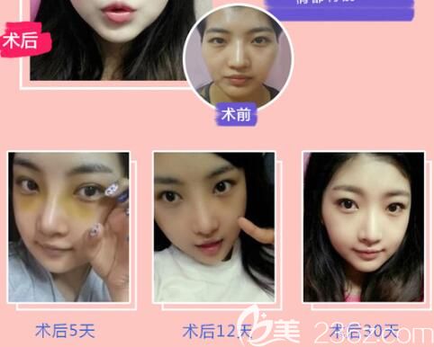 遵义利美康自体脂肪全脸填充 遵义利美康自体脂肪全脸填充