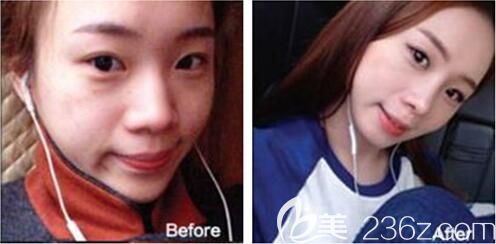 遵义利美康隆鼻好不好 遵义利美康隆鼻好不好