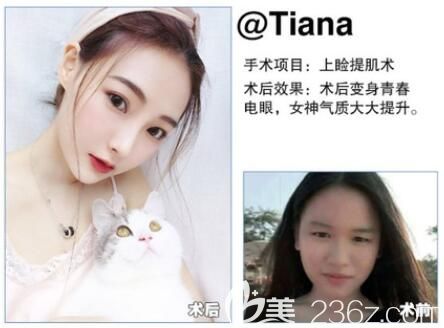 利美康上睑提肌矫正 利美康上睑提肌矫正