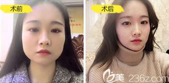 遵义利美康黄磊兵瘦脸案例 遵义利美康黄磊兵瘦脸案例