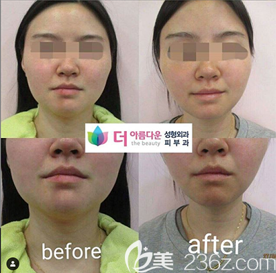 韩国thebuty整形外科真申稼面部吸脂案例