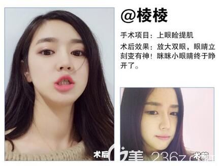 遵义利美康上眼睑提肌矫正