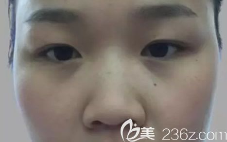 呼和浩华美整形美容综合隆鼻前 呼和浩华美整形美容综合隆鼻前