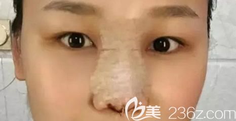 自体软骨综合隆鼻第二天效果 自体软骨综合隆鼻第二天效果