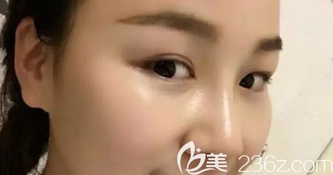 呼市华美鼻部综合手术第七天拆线后图片 呼市华美鼻部综合手术第七天拆线后图片