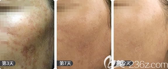 杭州薇琳陈丹激光祛黄褐斑<span style= 杭州薇琳陈丹激光祛黄褐斑<span style=