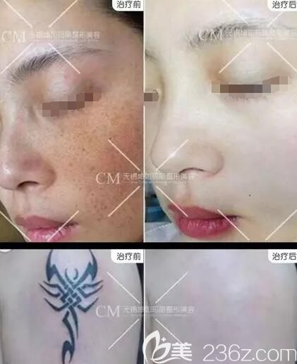 无锡坤如玛丽皮秒效果对比案例 无锡坤如玛丽皮秒效果对比案例