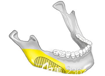 长曲线修身下颚体缩小 长曲线修身下颚体缩小