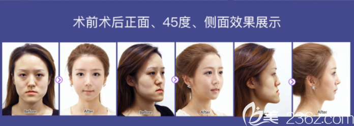face-line整形医轮廓案例 face-line整形医轮廓案例