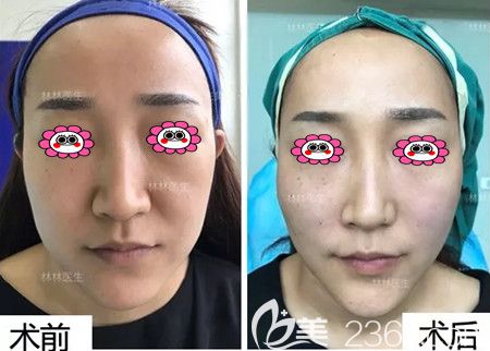 线雕前后效果图