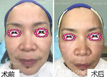 埋线提升变化图