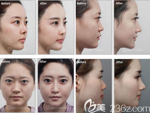 崔寓植院长隆鼻手术案例