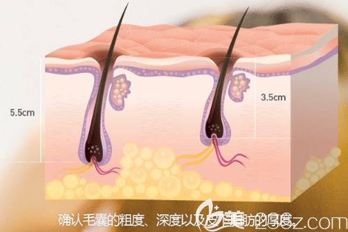 韩国毛杰琳发际线移植原理