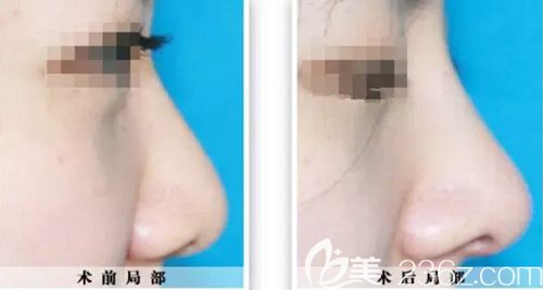 整形医院做假体隆鼻案例 整形医院做假体隆鼻案例
