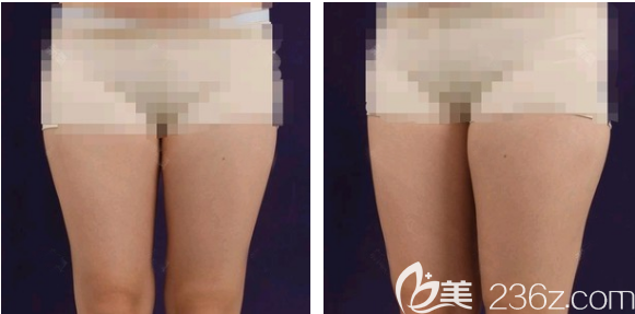 在东莞美立方做大腿吸脂手术前 在东莞美立方做大腿吸脂手术前