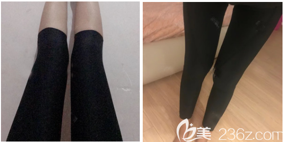 大腿吸脂减肥术后11天效果 大腿吸脂减肥术后11天效果