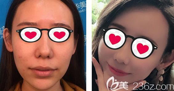 呼和浩特华美<!--<i data=20240703-sp></i>-->做全脸脂肪填充的效果怎么样 呼和浩特华美<!--<i data=20240703-sp></i>-->做全脸脂肪填充的效果怎么样