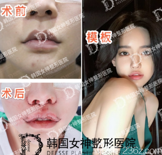 韩国女神整形医院明星项目——唇部整形