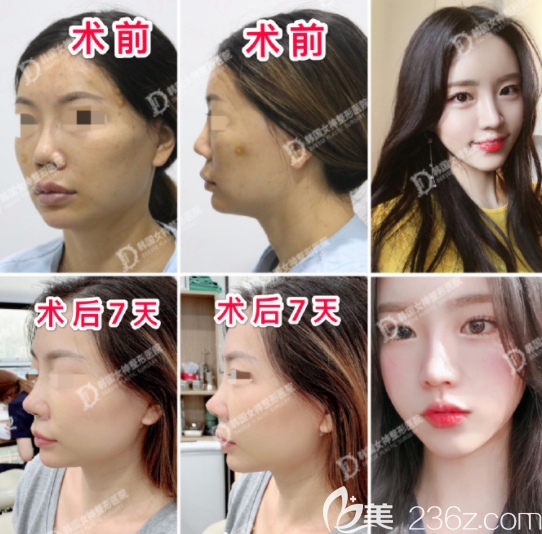 鼻子修复韩国女神 鼻子修复韩国女神