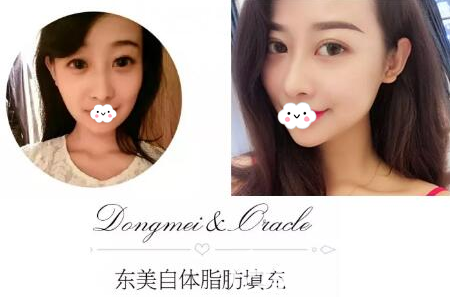 绵阳东美奥克拉卢元刚自体脂肪面部填充效果