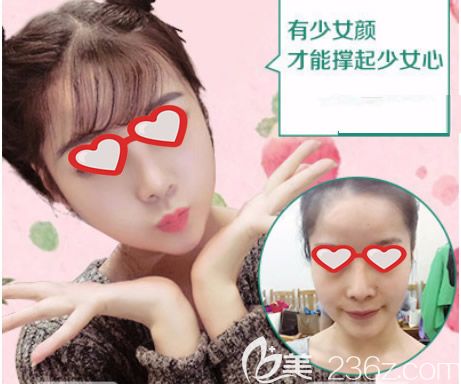 呼和浩特华美胡俊峰自体脂肪面部填充效果怎么样