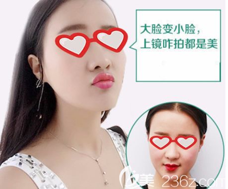 呼和浩特华美整形范志宏瘦脸除皱瘦脸前后效果对比照片