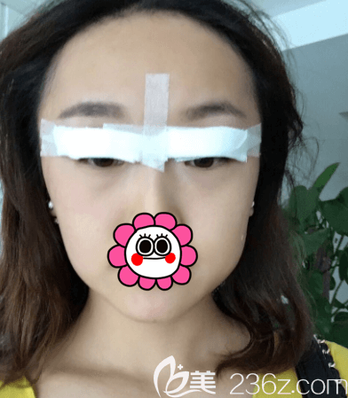 范宪红医生给我做埋线双眼皮第2天样子