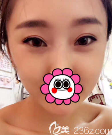 在北京艺美做埋线双眼皮第28天效果