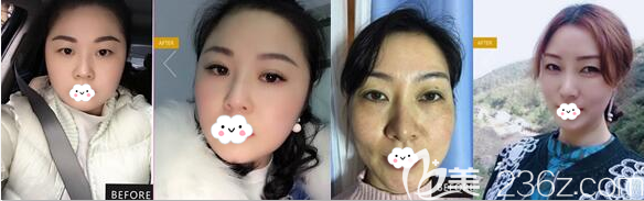 绵阳妙典双眼皮+脂肪填充面部案例