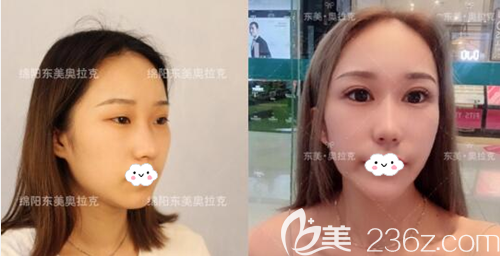 绵阳东美奥克拉整形周雪双眼皮术后对比照