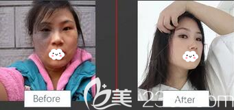 绵阳朗睿王步礼祛太田痣真实案例