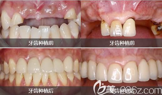 <!--<i data=20240703-sp></i>-->口腔牙齿种植前后对比图 <!--<i data=20240703-sp></i>-->口腔牙齿种植前后对比图